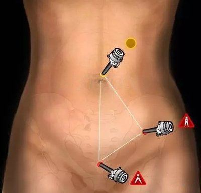 腹部套管针展示位置